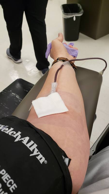 A person has their arm laying on an arm rest. The person has a piece of cloth covering a needle, and the needle is attached to a tube. The person is holding a squeeze ball wrapped in a disposable purple glove. 